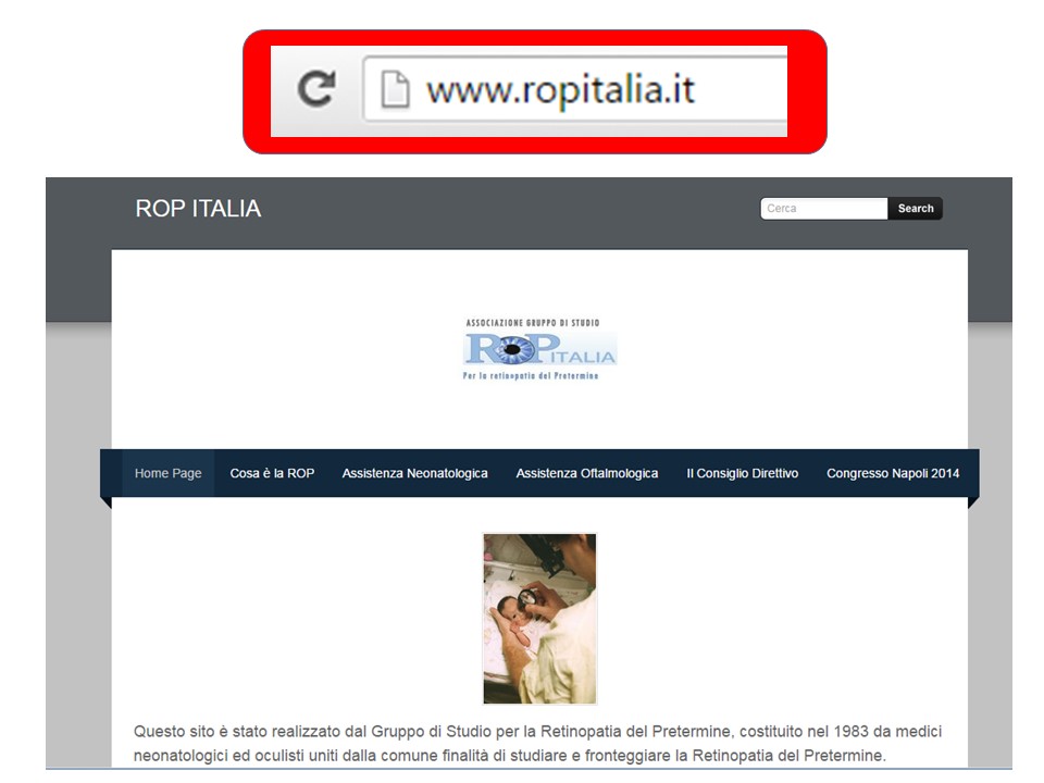 Retinopatia del prematuro (ROP) - Malattia vascolare della retina nei neonati pretermine