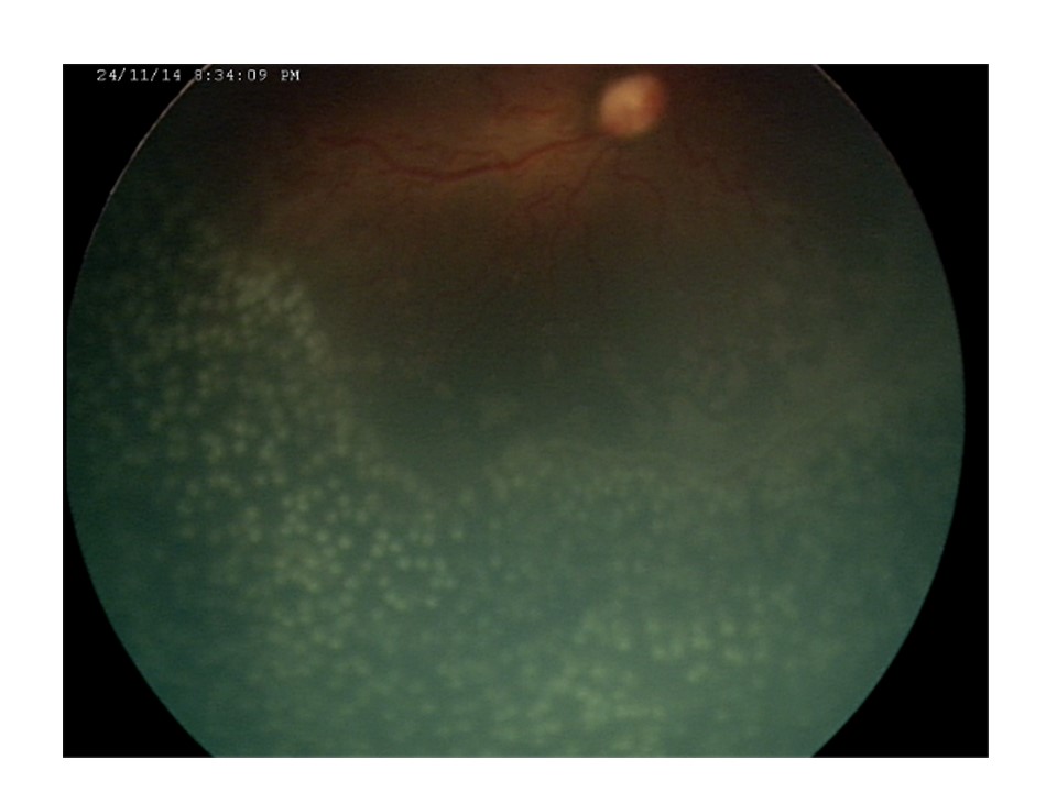 Retinopatia del prematuro (ROP) - Malattia vascolare della retina nei neonati pretermine