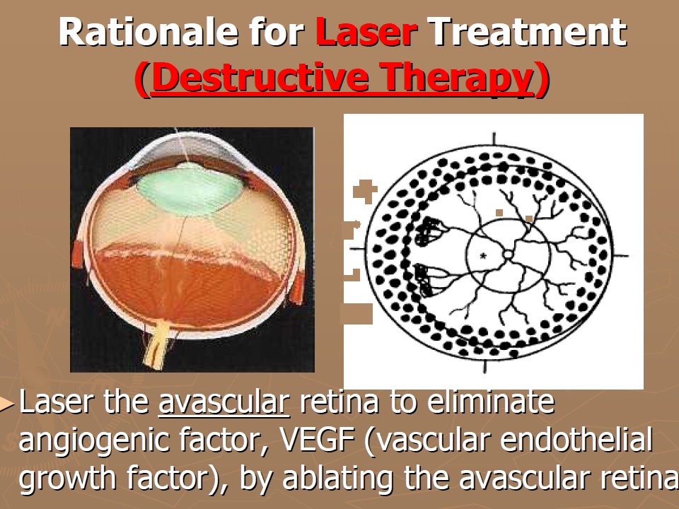Retinopatia del prematuro (ROP) - Malattia vascolare della retina nei neonati pretermine