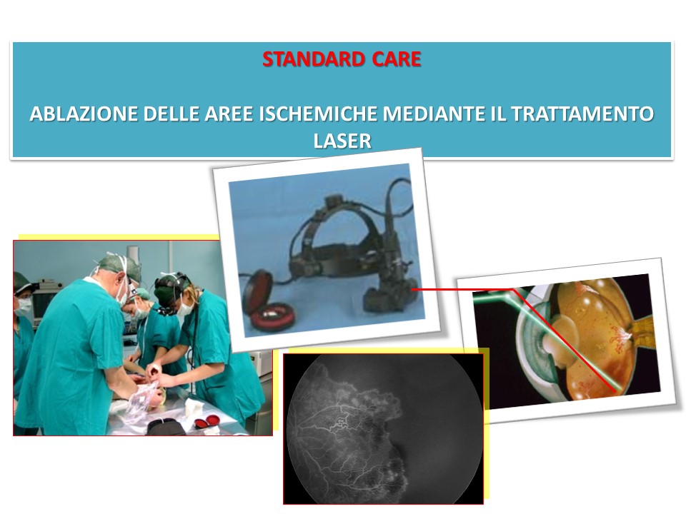 Retinopatia del prematuro (ROP) - Malattia vascolare della retina nei neonati pretermine
