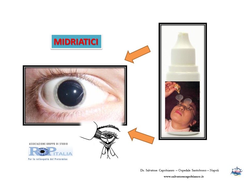 Retinopatia del prematuro (ROP) - Malattia vascolare della retina nei neonati pretermine