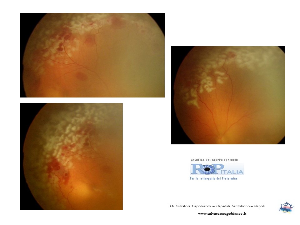 Retinopatia del prematuro (ROP) - Malattia vascolare della retina nei neonati pretermine