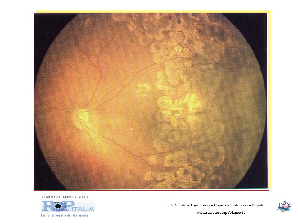 Retinopatia del prematuro (ROP) - Malattia vascolare della retina nei neonati pretermine
