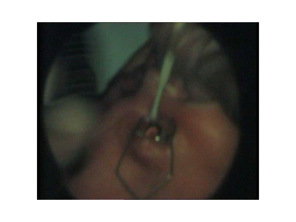 Retinopatia del prematuro (ROP) - Malattia vascolare della retina nei neonati pretermine
