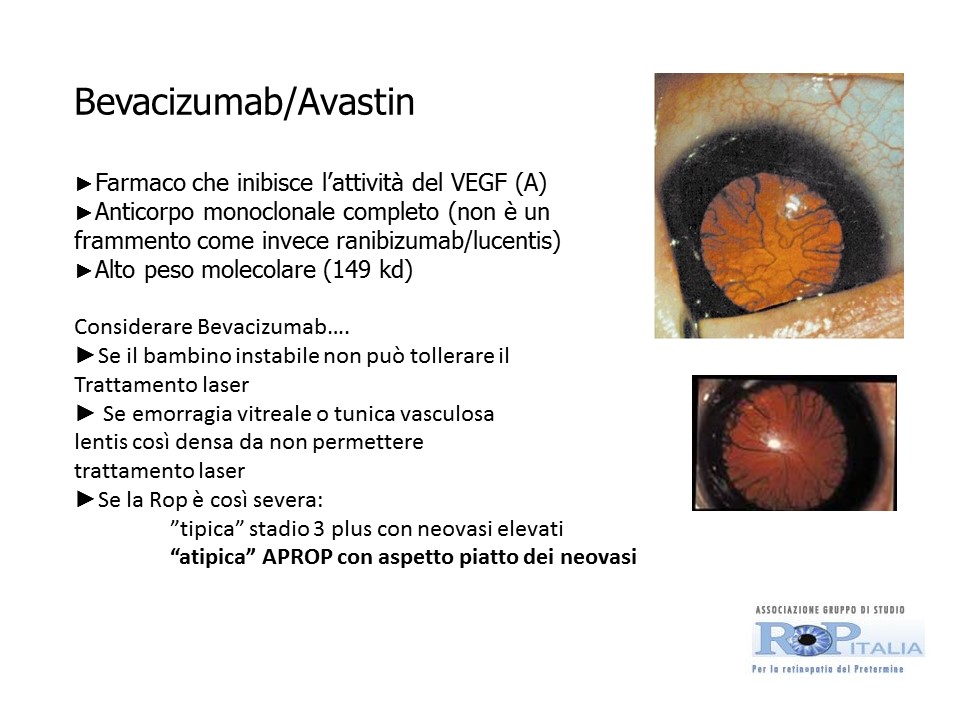 Retinopatia del prematuro (ROP) - Malattia vascolare della retina nei neonati pretermine
