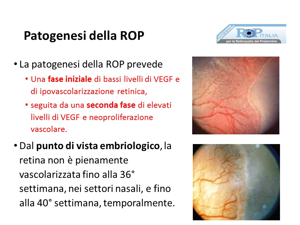 Retinopatia del prematuro (ROP) - Malattia vascolare della retina nei neonati pretermine