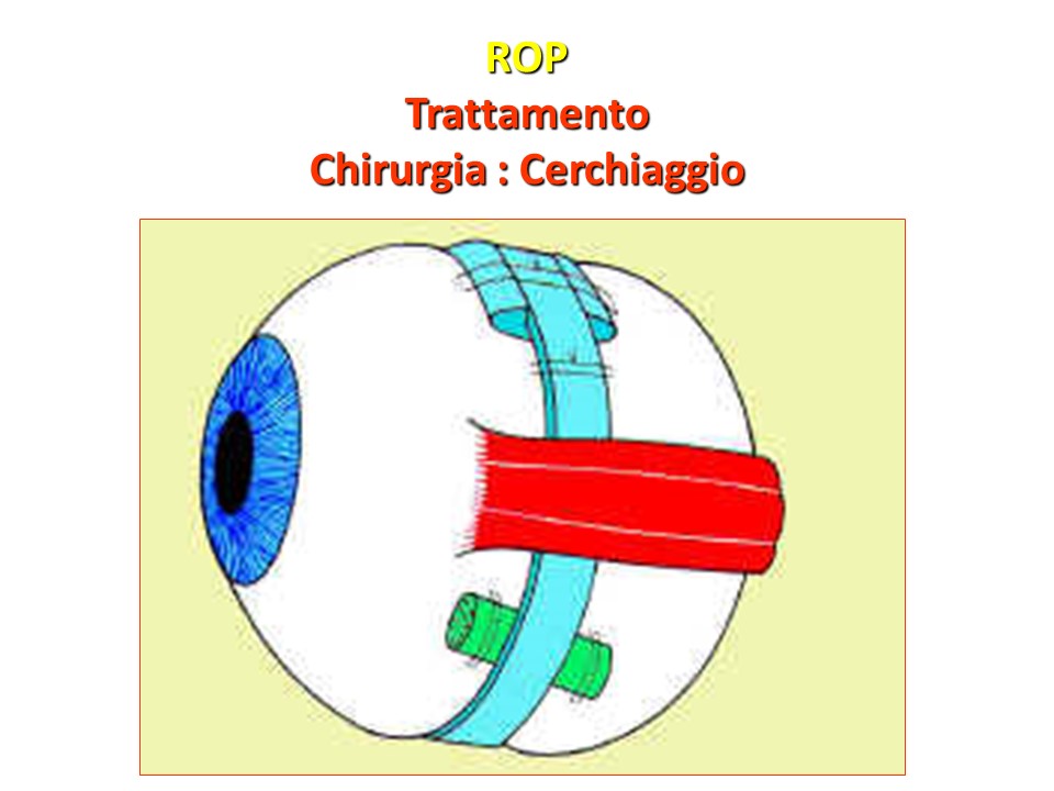 Retinopatia del prematuro (ROP) - Malattia vascolare della retina nei neonati pretermine