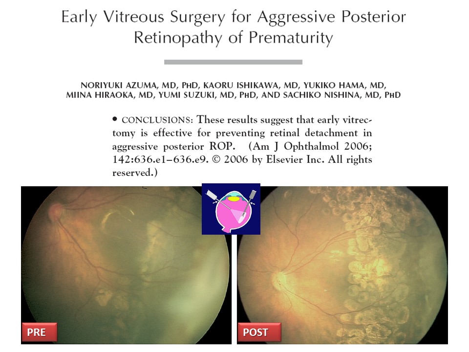 Retinopatia del prematuro (ROP) - Malattia vascolare della retina nei neonati pretermine