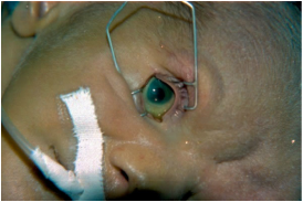 neonato-blefarostato