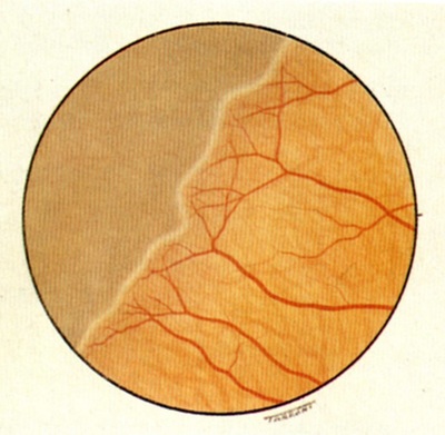 rop-i