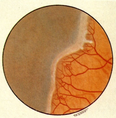 rop-ii